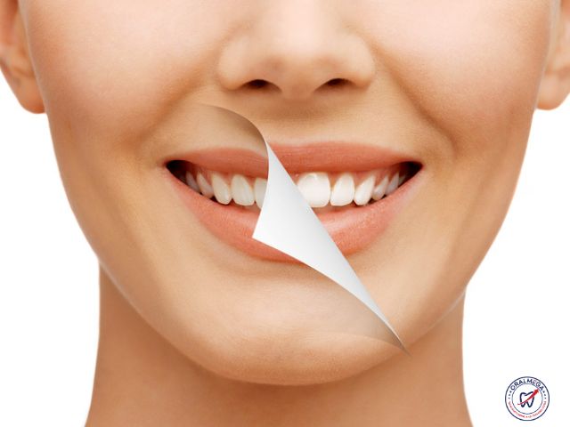 Smiling woman with teeth whitening effect.